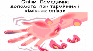 Презентація «Опіки. Домедична допомога при  термічних і хімічних опіках »