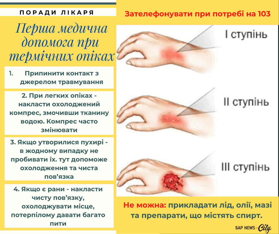 Як надати першу допомогу при опіку: основні правила та поради