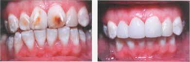Флюороз зубів: симптоми та лікування основних форм захворювання | Dental Art