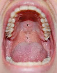 Uvulopalatopharyngoplasty: Overview, Periprocedural Care, Technique